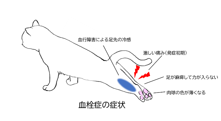 血栓症イメージ図